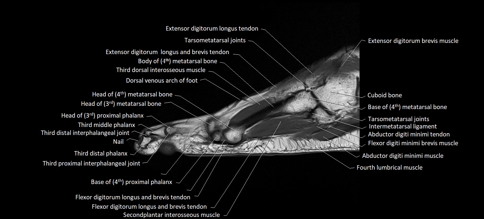 MRI foot sagittal labelled cross sectional anatomy image  18.webp